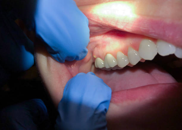 Best Emergency Treatment for Dental Infections or Abscesses in Deans, NJ